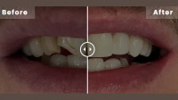 Composite Bonding