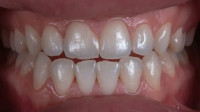 White Fillings