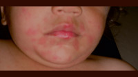 Anaphylaxis First Aid Training