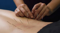 Dry Needling